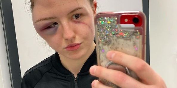 Cheyenne Hanson zeigte auf Instagram ihre Verletzungen.